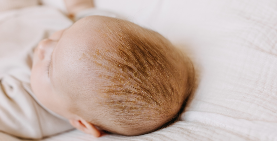 Berg op de hoofdhuid van een baby