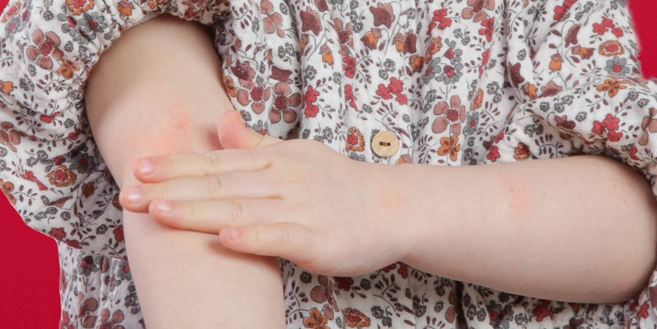 Armen van een kind die eczeem heeft