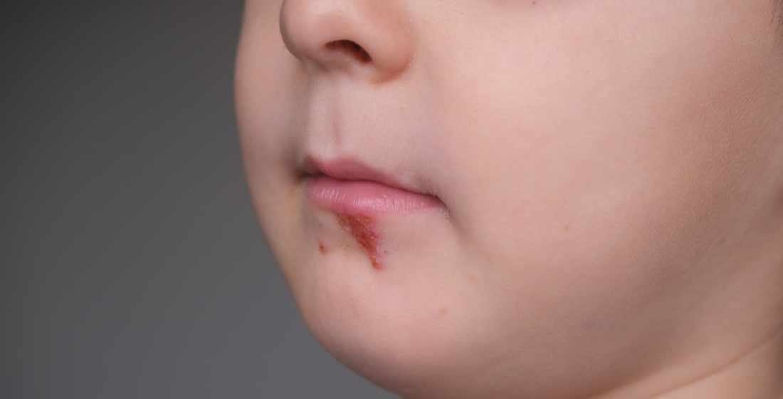 Peuter met koortslip