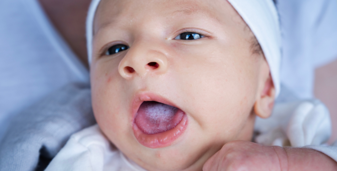 Baby met een witte tong door spruw